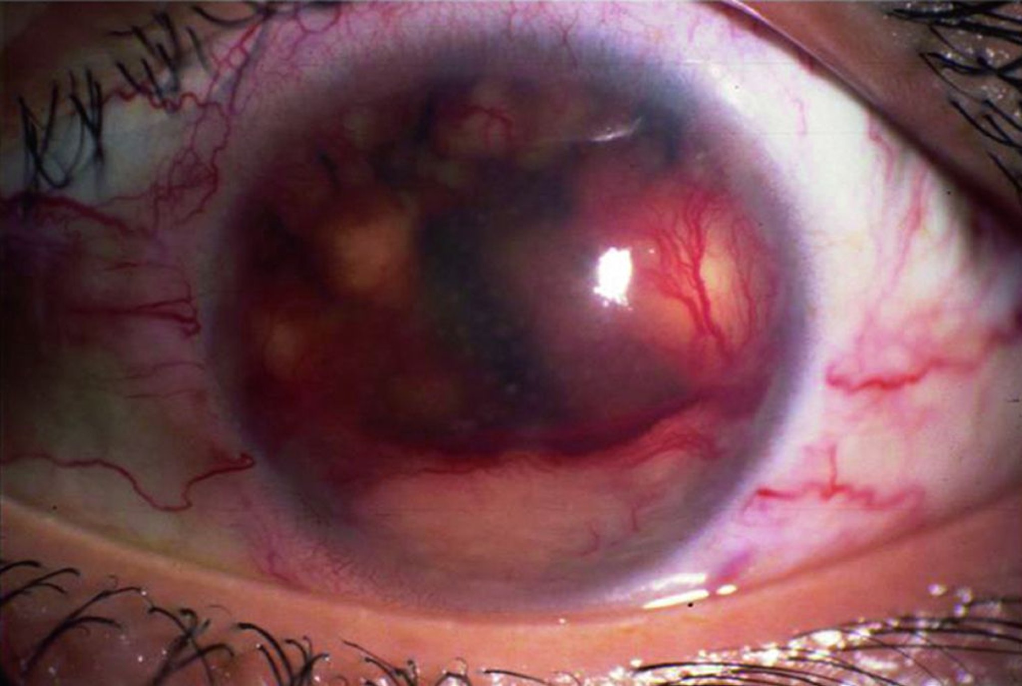 Sarcoidosis (granuloma del iris)