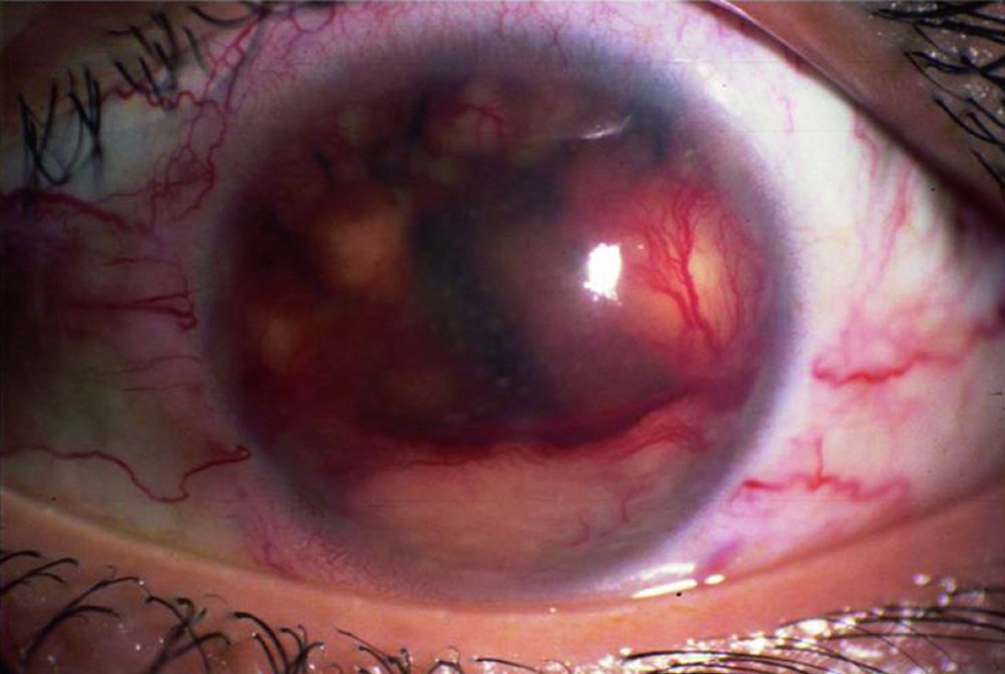 Sarcoïdose (granulome de l'iris)