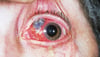 Necrotizing Scleritis