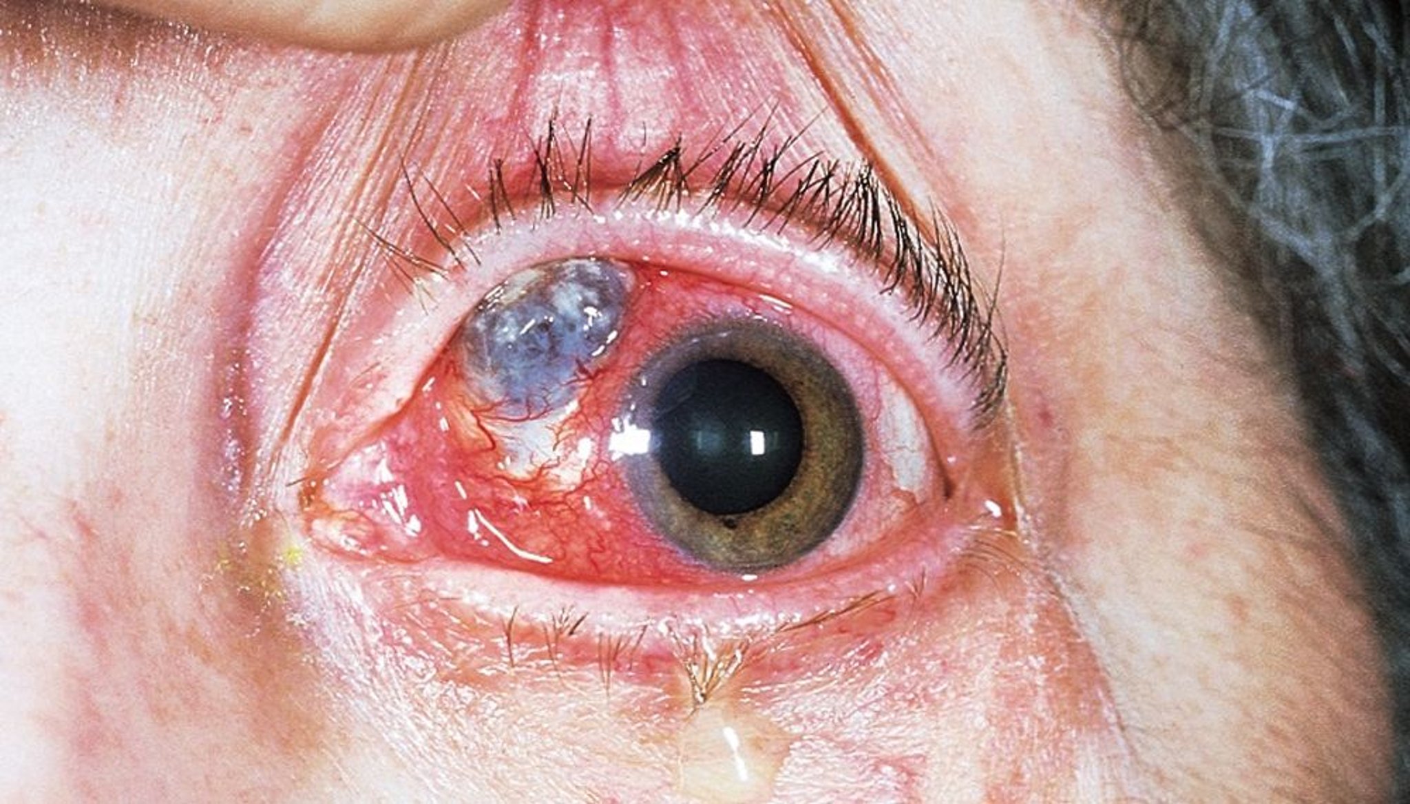 Esclerite necrosante