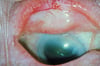 トラコーマ性瘢痕期（trachomatous scarring：TS）と角膜混濁期（corneal opacity ［CO］）
