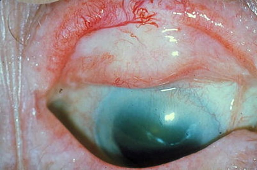 トラコーマ性瘢痕期（trachomatous scarring：TS）と角膜混濁期（corneal opacity ［CO］）