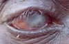 トラコーマ性睫毛乱生期（trachomatous trichiasis：TT）と角膜混濁期（corneal opacity：CO）