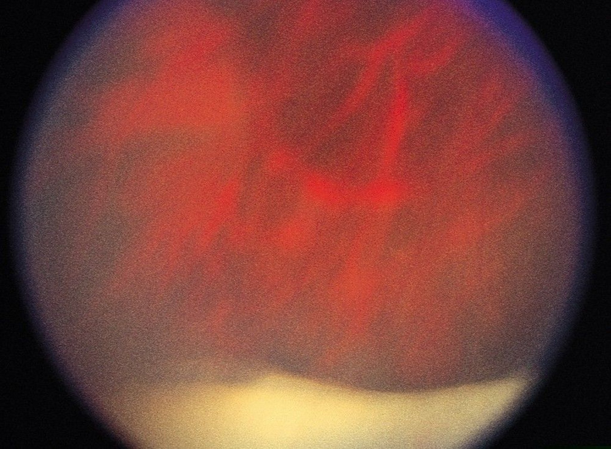 Uveitis (Intermediate)
