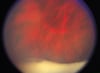 Uveitis (intermediär)