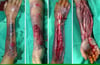 Necrotizing Fasciitis