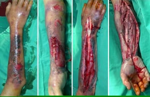 Necrotizing Fasciitis