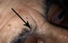 Uremic Frost