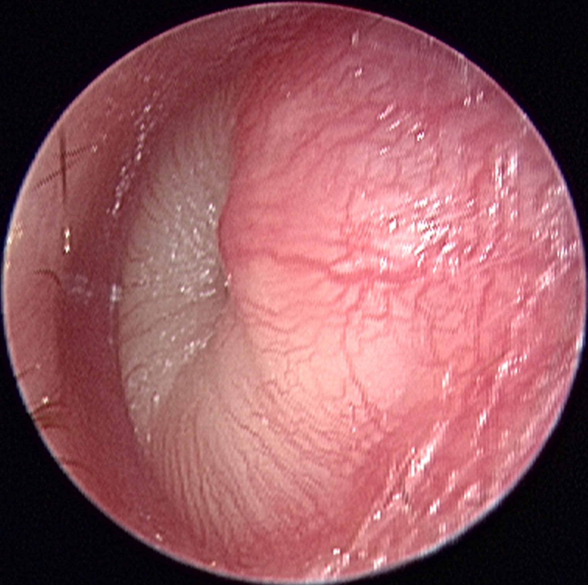 Acute Otitis Media