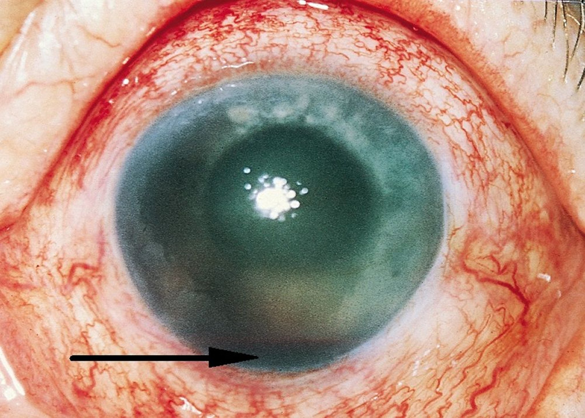 Hemorragia da câmara anterior (hifema)