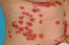 Lineare IgA-Dermatose