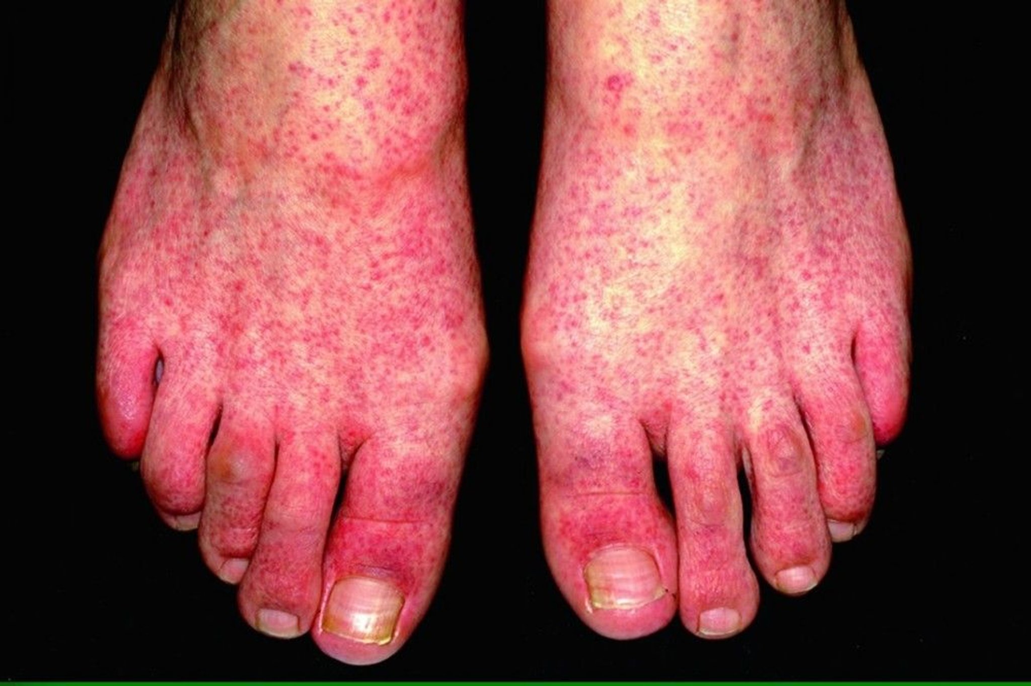 Papular-Purpuric Gloves-and-Socks Syndrome