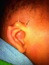 Fossettes d'oreille