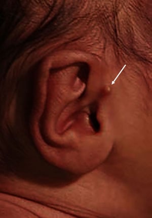 Maraca auricular