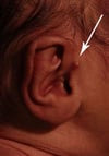 Auricule accessoire