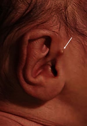 Mảnh da ở tai