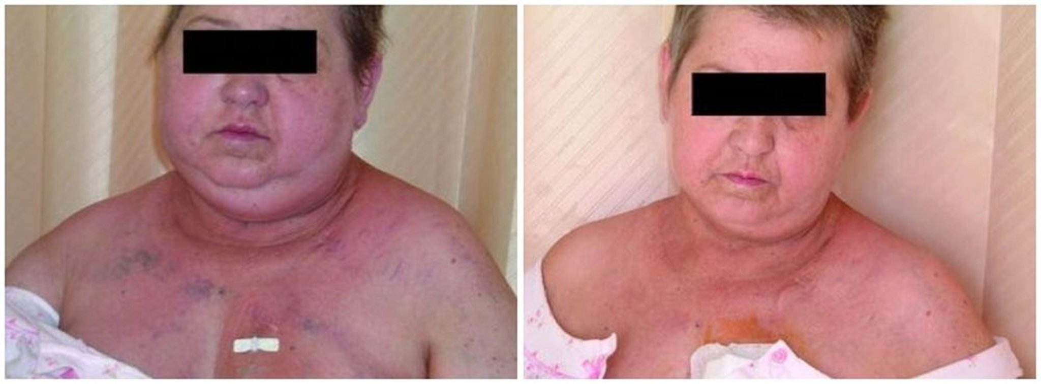 Sindrome della vena cava superiore
