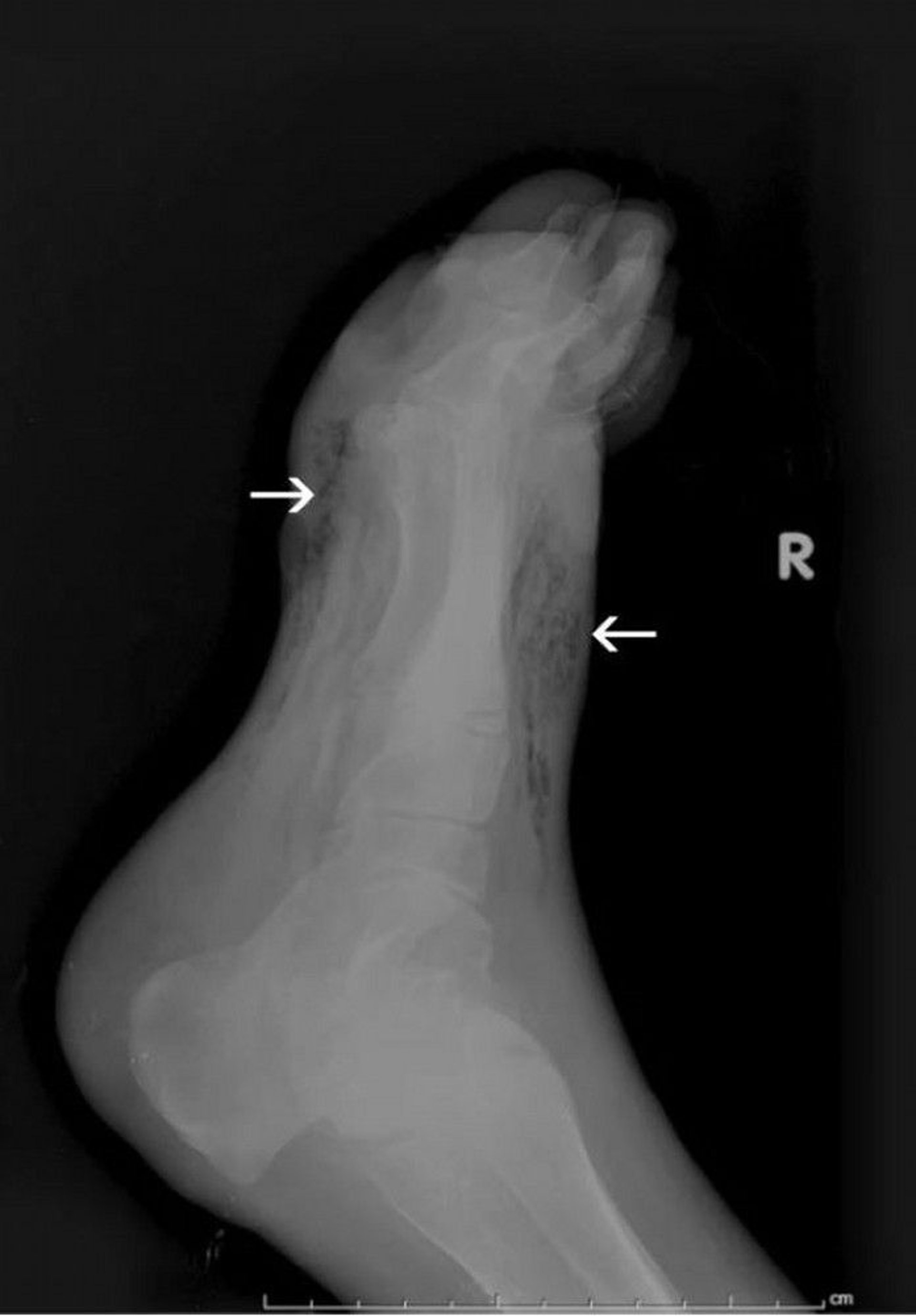 Myonecrosis (Gangrene) of the Foot (Radiograph)