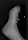 Gangrène du pied (rx)