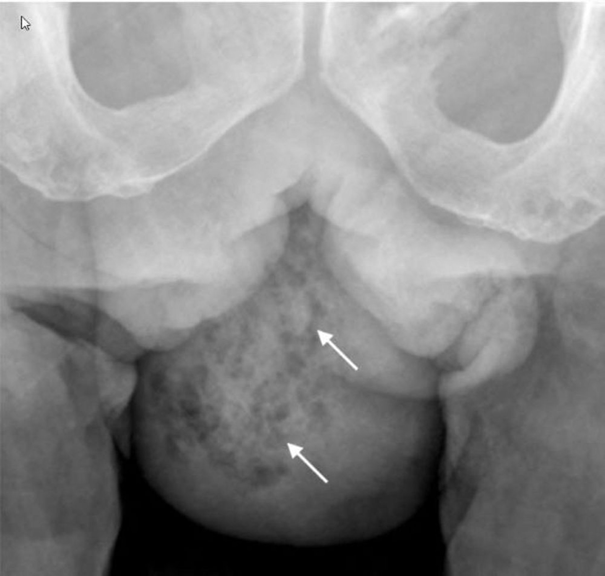 Gangrena di Fournier (radiografia)