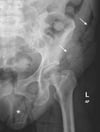 Fournier Gangrene (Abdominal X-Ray)