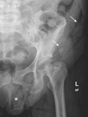 Gangrena de Fournier (Radiografia abdominal)
