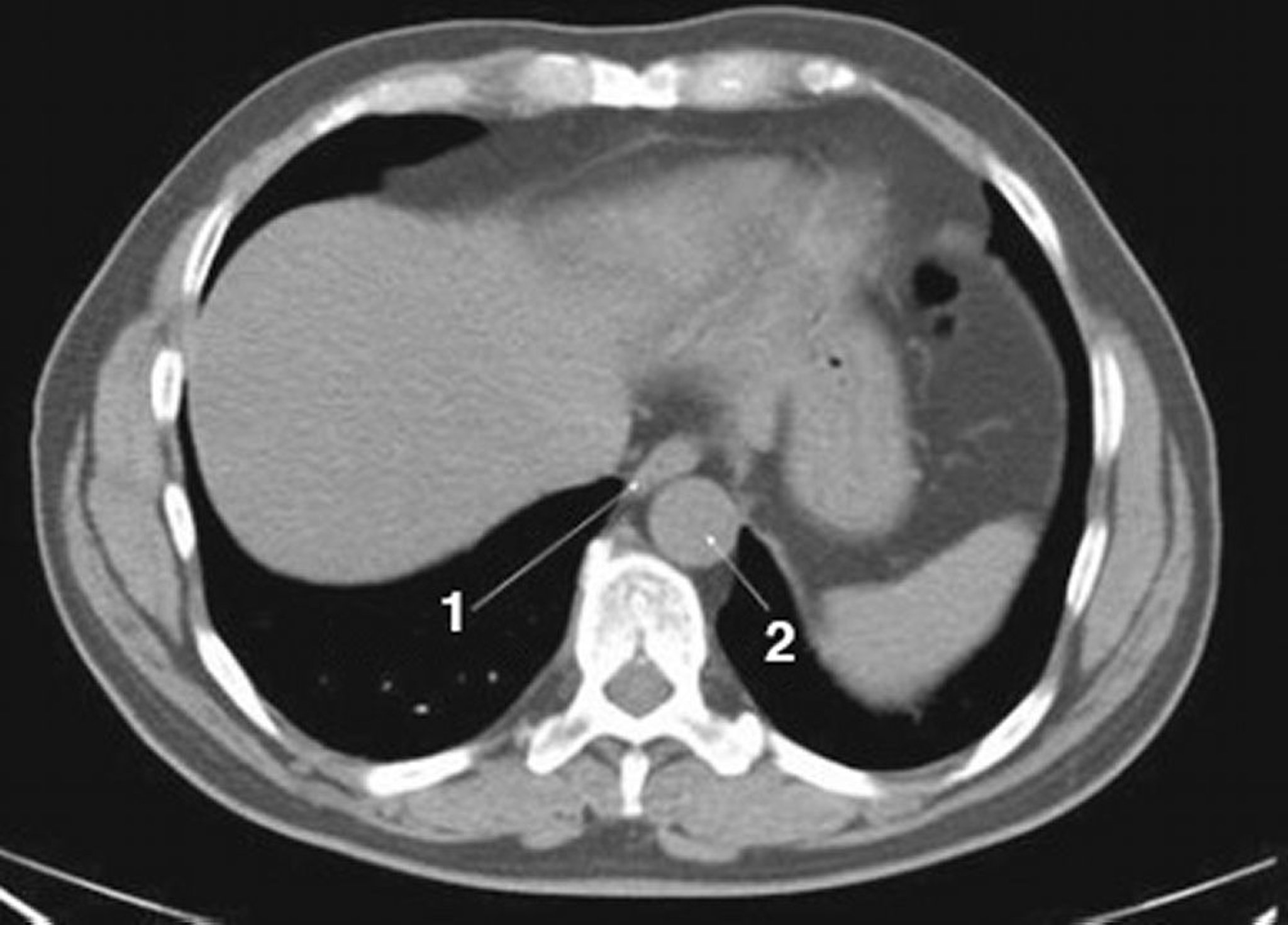 Noncontrast CT Scan of the Abdomen and Pelvis Showing Normal Anatomy (Slide 1)