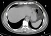 Noncontrast CT Scan of the Abdomen and Pelvis Showing Normal Anatomy (Slide 2)