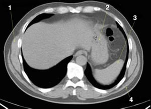 TDM sans contraste de l'abdomen et du bassin montrant une anatomie normale (diapositive 2)
