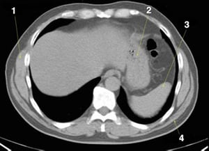 Phim chụp CT vùng bụng và xương chậu không thuốc cản quang cho thấy giải phẫu bình thường (lát cắt 2)