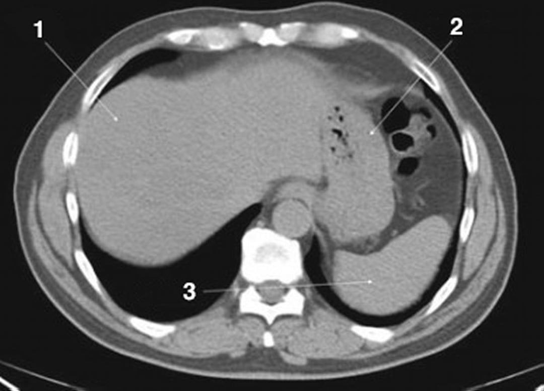 Image:Noncontrast CT Scan of the Abdomen and Pelvis Showing Normal ...