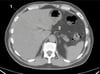 Noncontrast CT Scan of the Abdomen and Pelvis Showing Normal Anatomy (Slide 4)