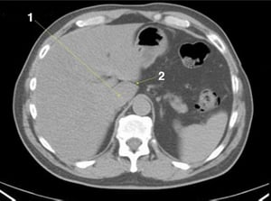 Phim chụp CT vùng bụng và xương chậu không thuốc cản quang cho thấy giải phẫu bình thường (lát cắt 4)