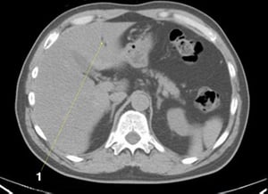 Tomografía computarizada sin contraste de abdomen y pelvis que muestra anatomía normal (corte 5)