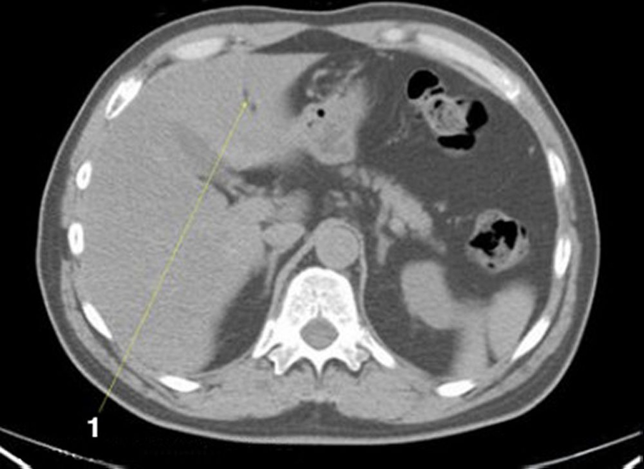 TDM sans contraste de l'abdomen et du bassin montrant une anatomie normale (diapositive 5)