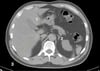 TDM sans contraste de l'abdomen et du bassin montrant une anatomie normale (diapositive 6)
