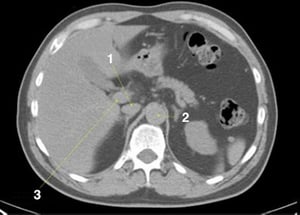 TDM sans contraste de l'abdomen et du bassin montrant une anatomie normale (diapositive 6)