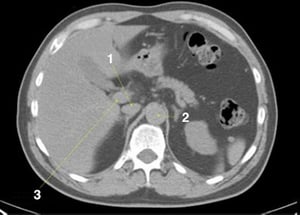 Phim chụp CT vùng bụng và xương chậu không thuốc cản quang cho thấy giải phẫu bình thường (lát cắt 6)