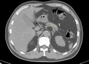 Phim chụp CT vùng bụng và xương chậu không thuốc cản quang cho thấy giải phẫu bình thường (lát cắt 7)
