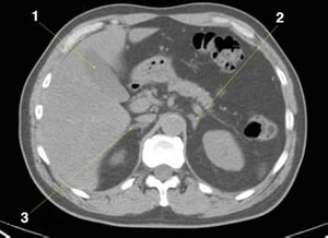 Noncontrast CT Scan of the Abdomen and Pelvis Showing Normal Anatomy (Slide 8)