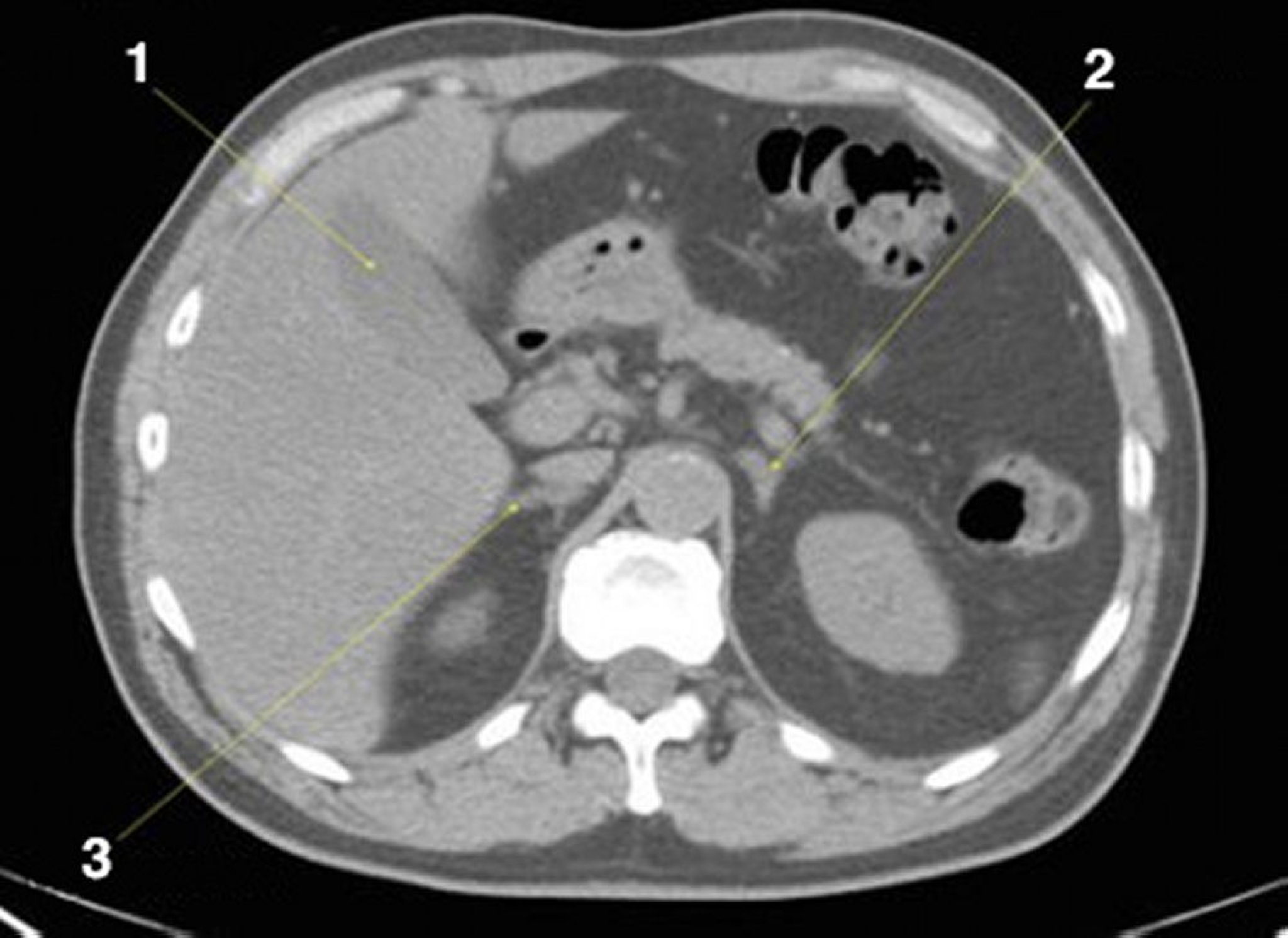 TDM sans contraste de l'abdomen et du bassin montrant une anatomie normale (diapositive 8)