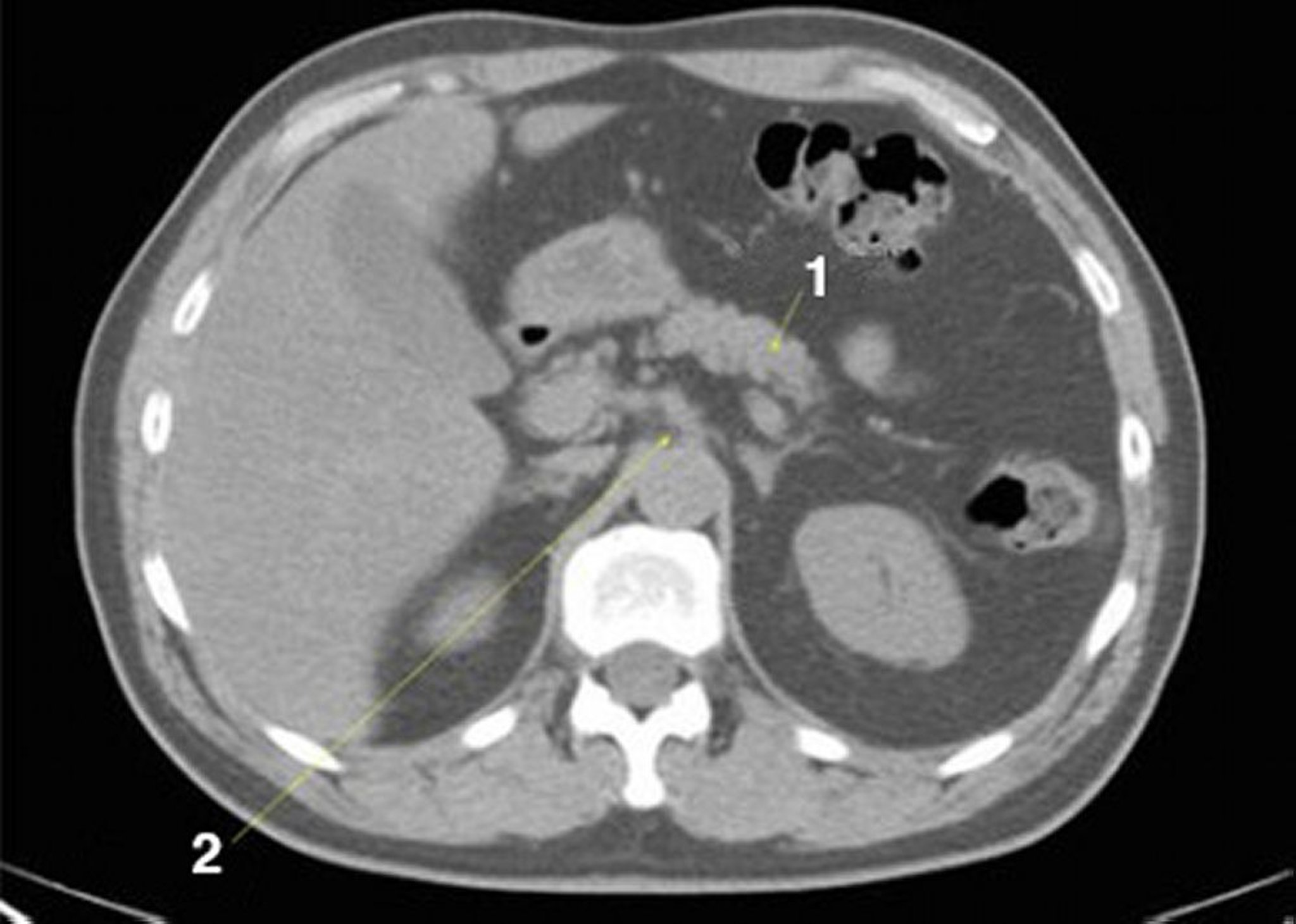 Tomografía computarizada sin contraste de abdomen y pelvis que muestra anatomía normal (corte 9)