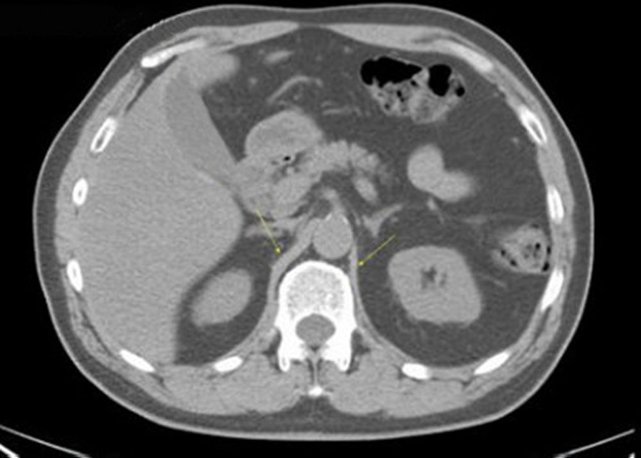 CT-Scan von Abdomen und Becken mit normaler Anatomie ohne Kontrastmittel (Folie 10)