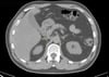 TDM sans contraste de l'abdomen et du bassin montrant une anatomie normale (diapositive 10)