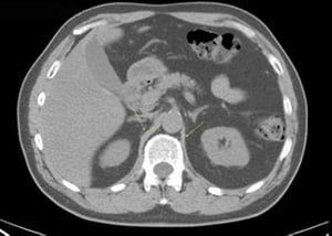 TDM sans contraste de l'abdomen et du bassin montrant une anatomie normale (diapositive 10)