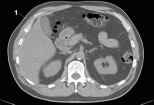 TDM sans contraste de l'abdomen et du bassin montrant une anatomie normale (diapositive 11)
