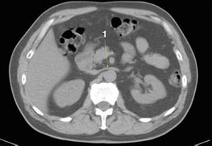 TDM sans contraste de l'abdomen et du bassin montrant une anatomie normale (diapositive 12)