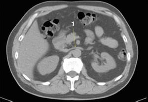 Phim chụp CT vùng bụng và xương chậu không thuốc cản quang cho thấy giải phẫu bình thường (lát cắt 12)