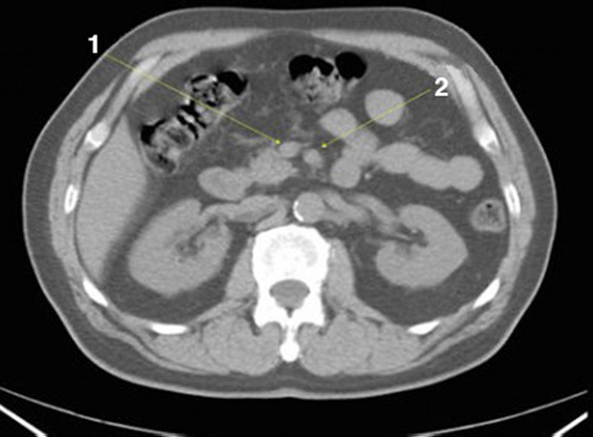 Tomografía computarizada sin contraste de abdomen y pelvis que muestra anatomía normal (corte 13)