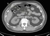 TDM sans contraste de l'abdomen et du bassin montrant une anatomie normale (diapositive 13)